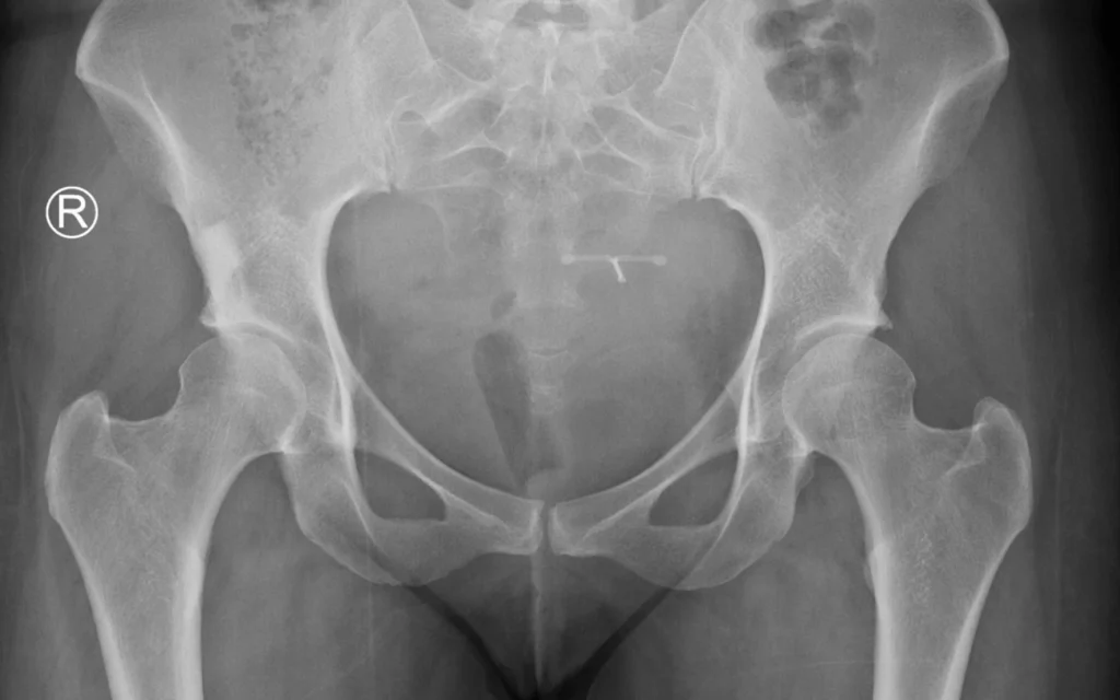 hip arthritis