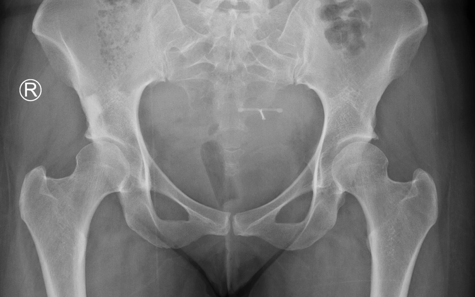hip arthritis