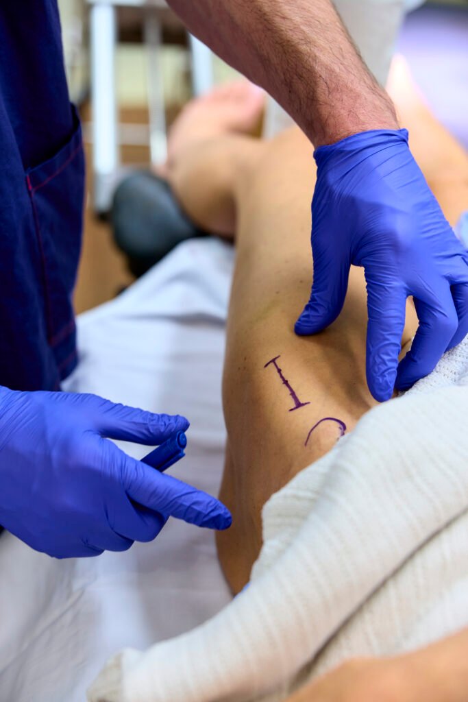 Direct Anterior Approach Hip Replacement Incision