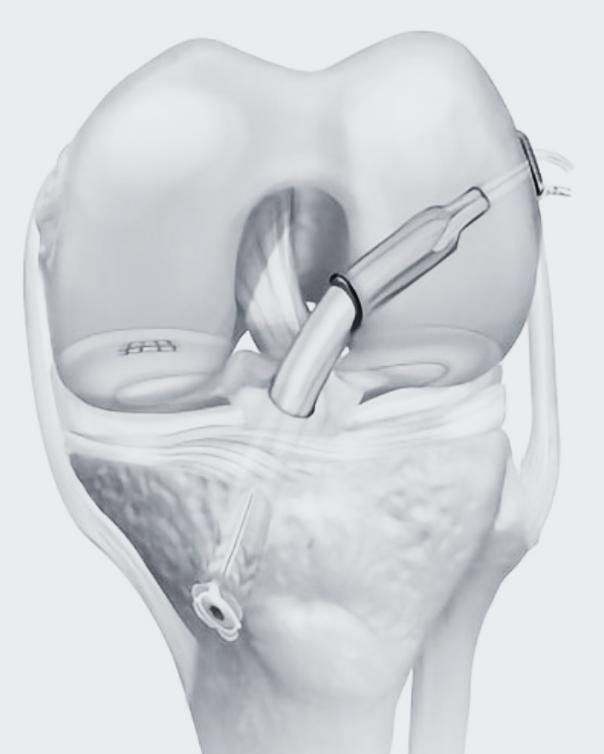acl reconstruction adelaide