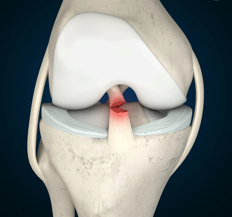 acl tear or injury adelaide