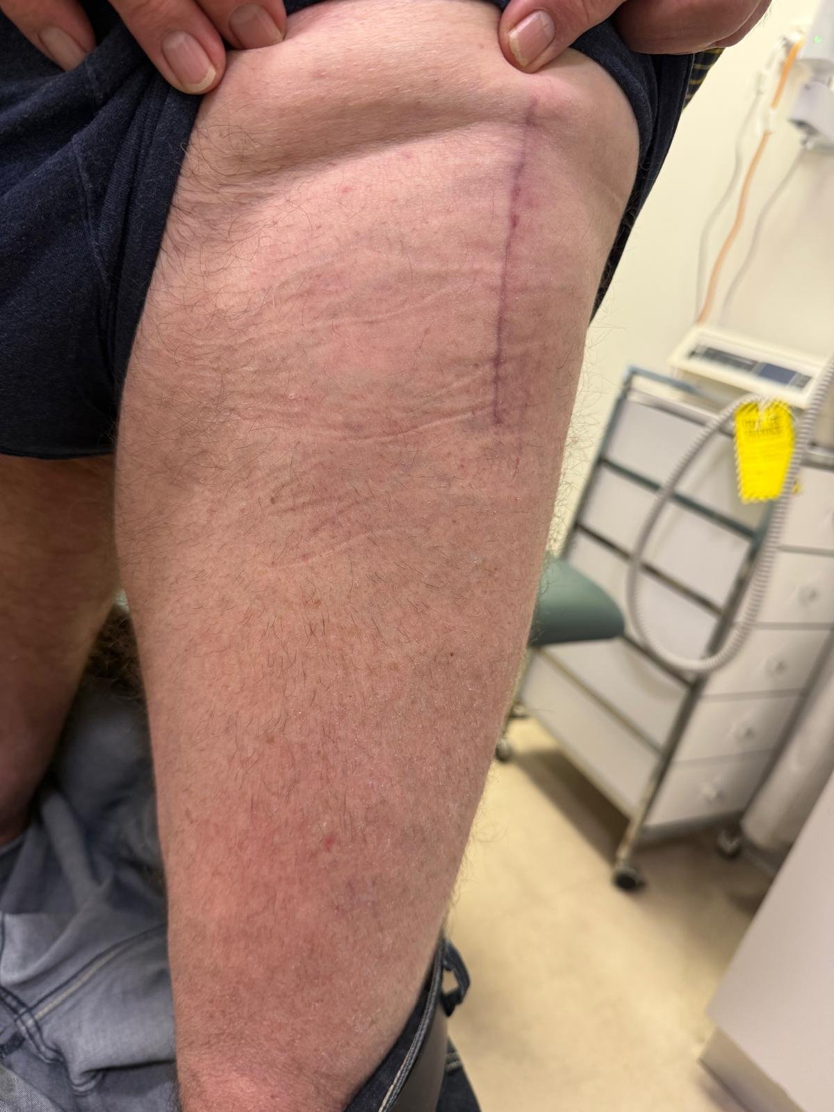 anterior approach total hip replacement scar adelaide