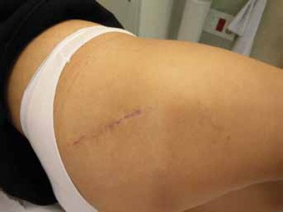 anterolateral approach tha scar