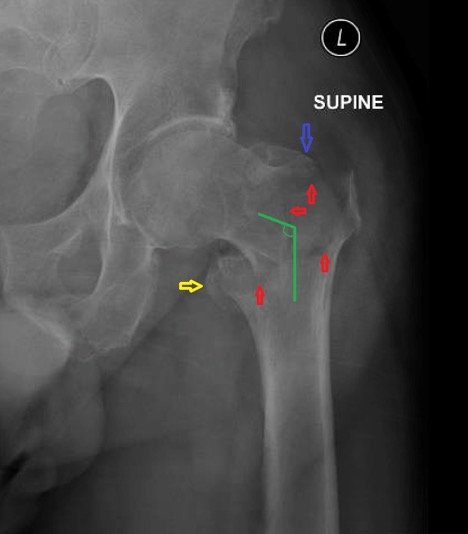 intertrochanteric hip fracture adelaide