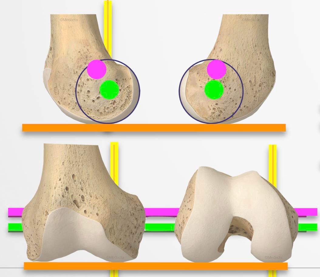 kinematic alignment tka adelaide