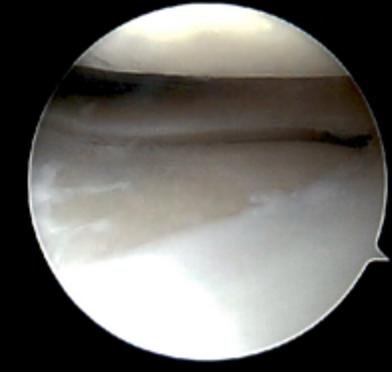 knee arthroscopy adelaide