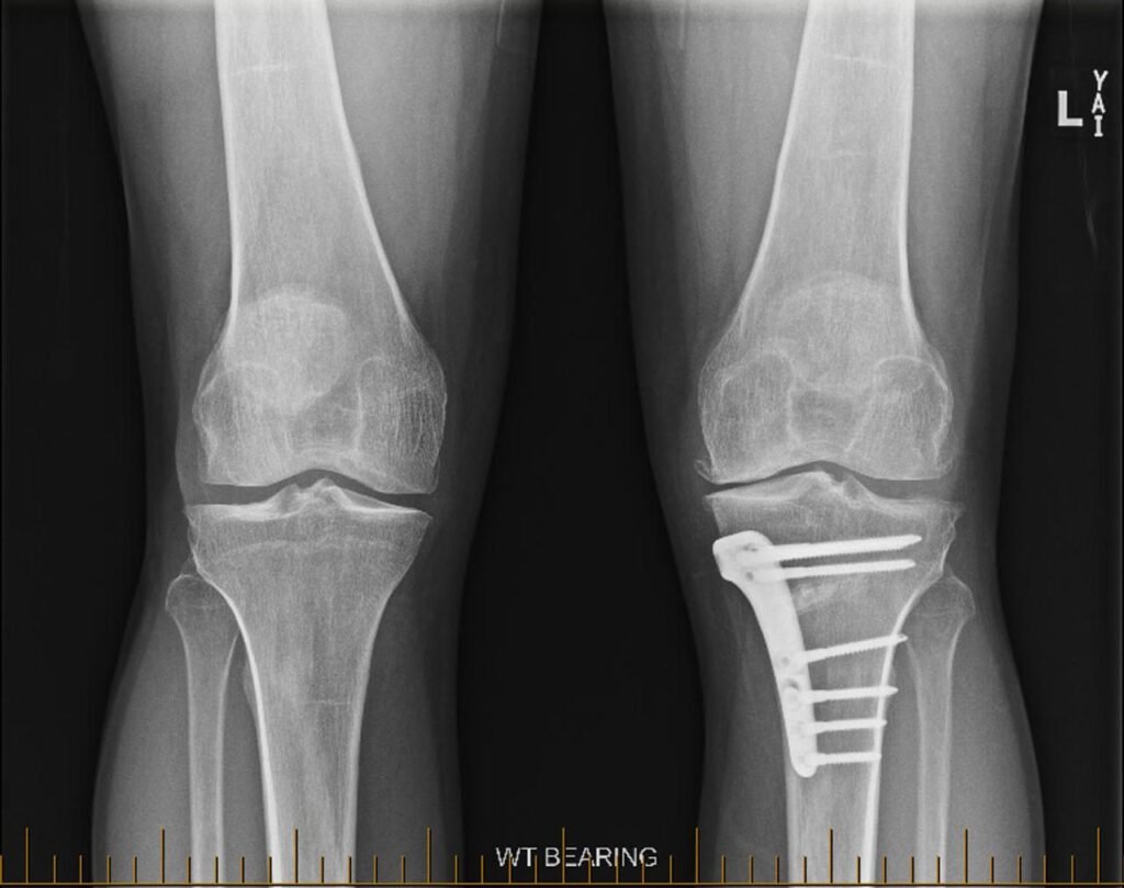 knee osteotomy xray adelaide