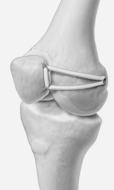 mpfl reconstruction adelaide