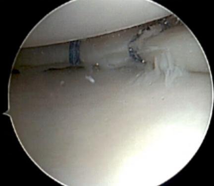 meniscal repair adelaide