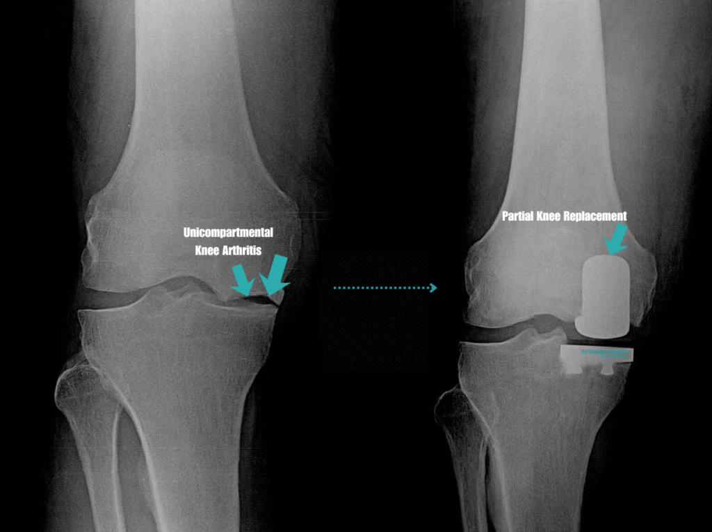 partial knee replacement (1)