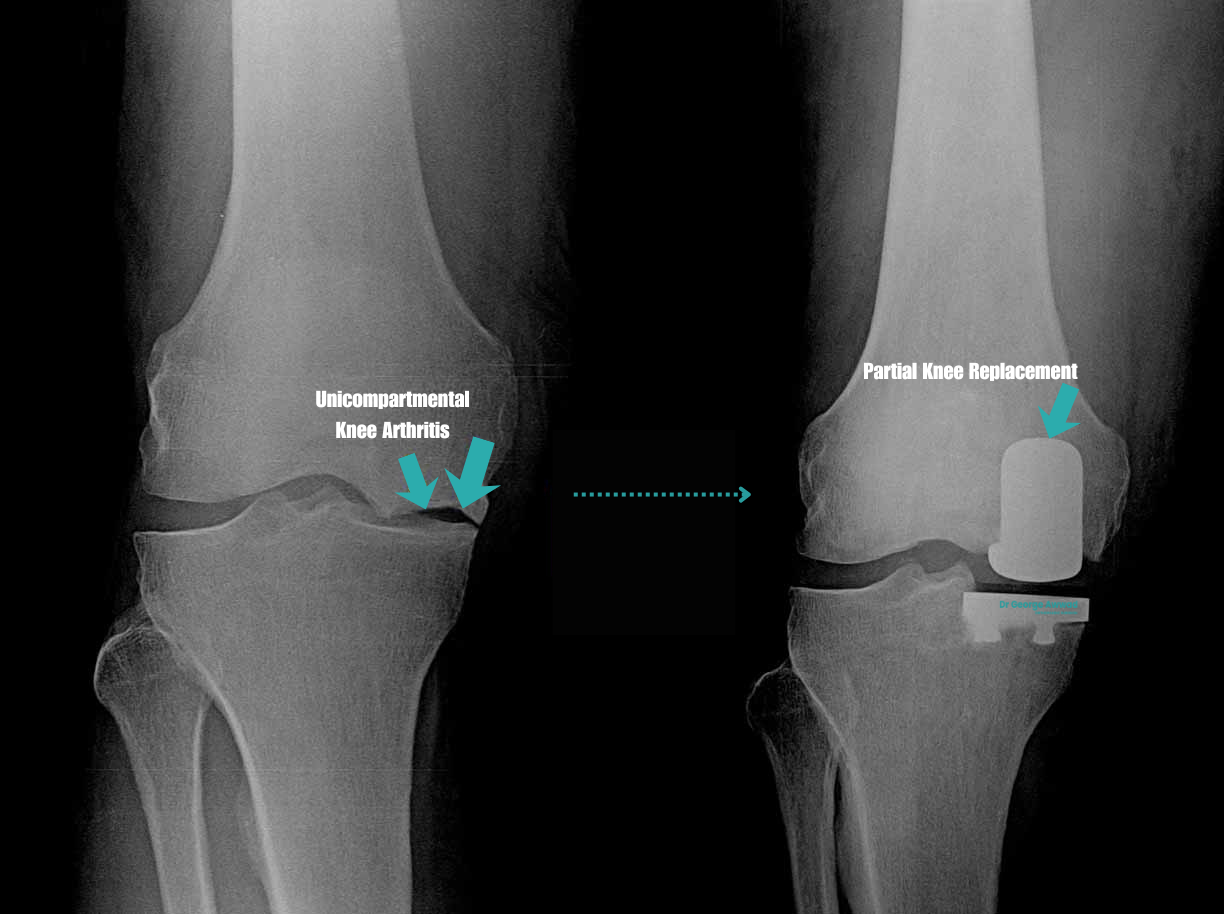 partial knee replacement (1)