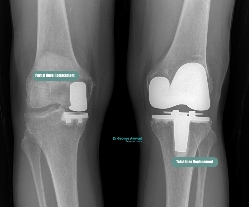partial vs total knee replacement