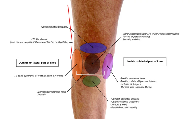 patellofemoral instability & pain