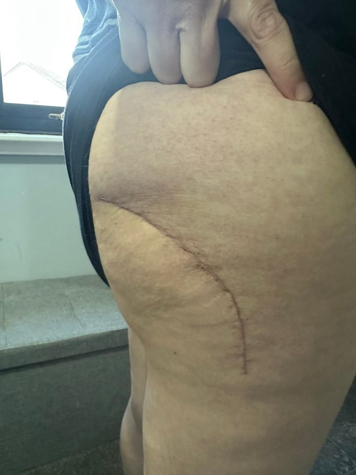 posterior appraoch total hip replacement scar adelaide