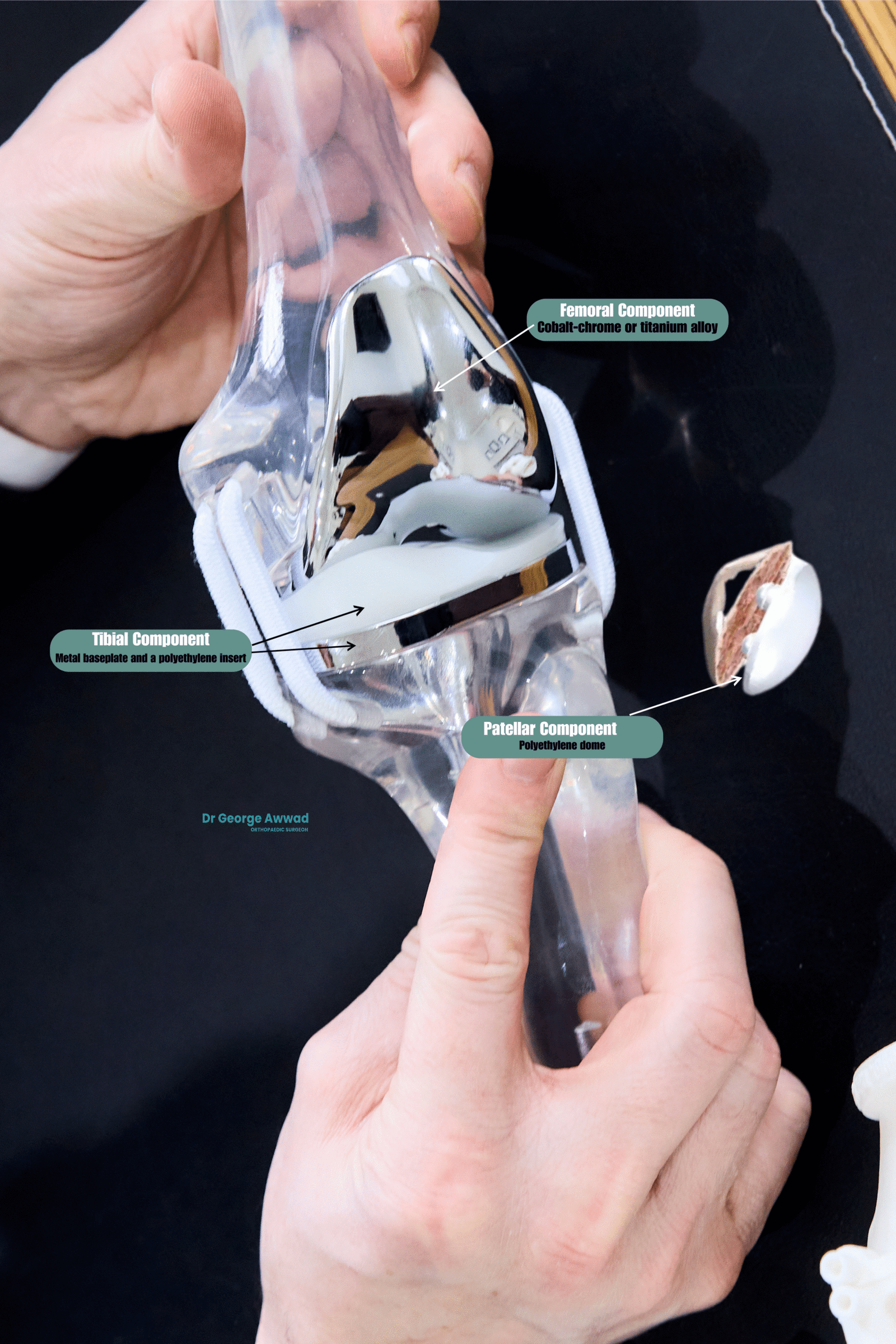 total knee replacement implant components adelaide