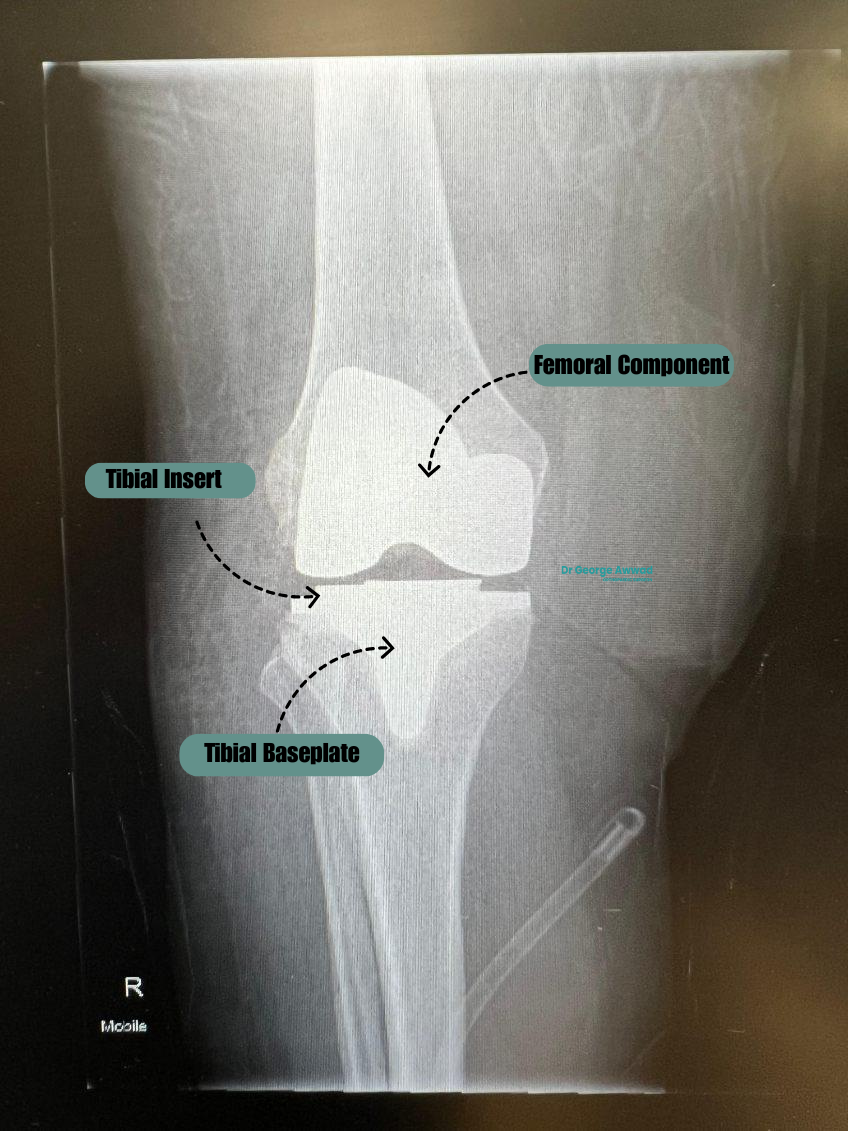 total knee replacement x ray adelaide