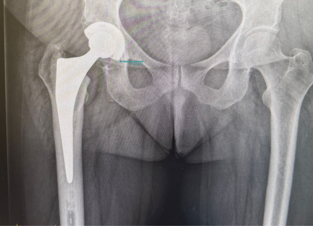 total hip replacement x ray adelaide (1)