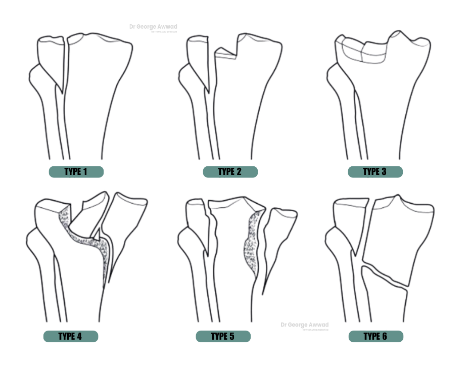 types of knee fractures adelaide