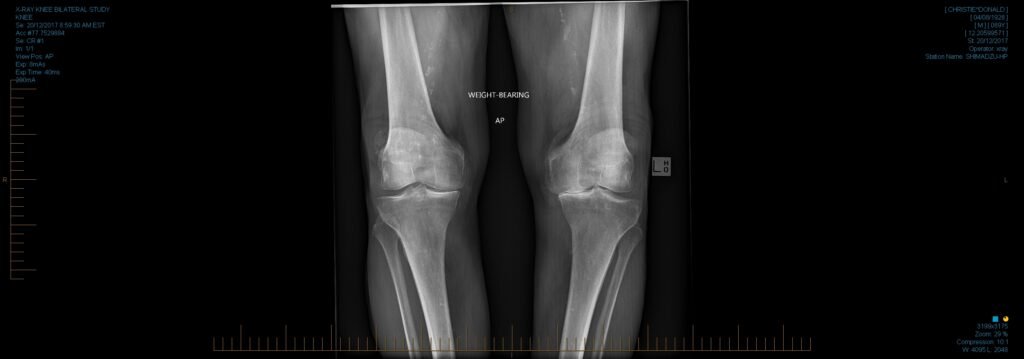 x ray knee right side 0003