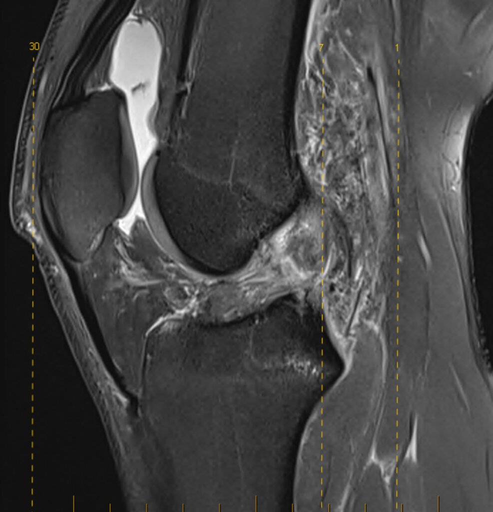 sagittal mri slice showing the typical location of the anterior cruciate ligament within the knee