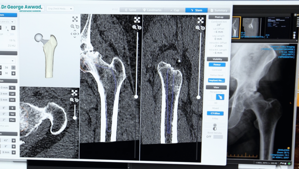 surgical planning in hip replacement surgery adelaide